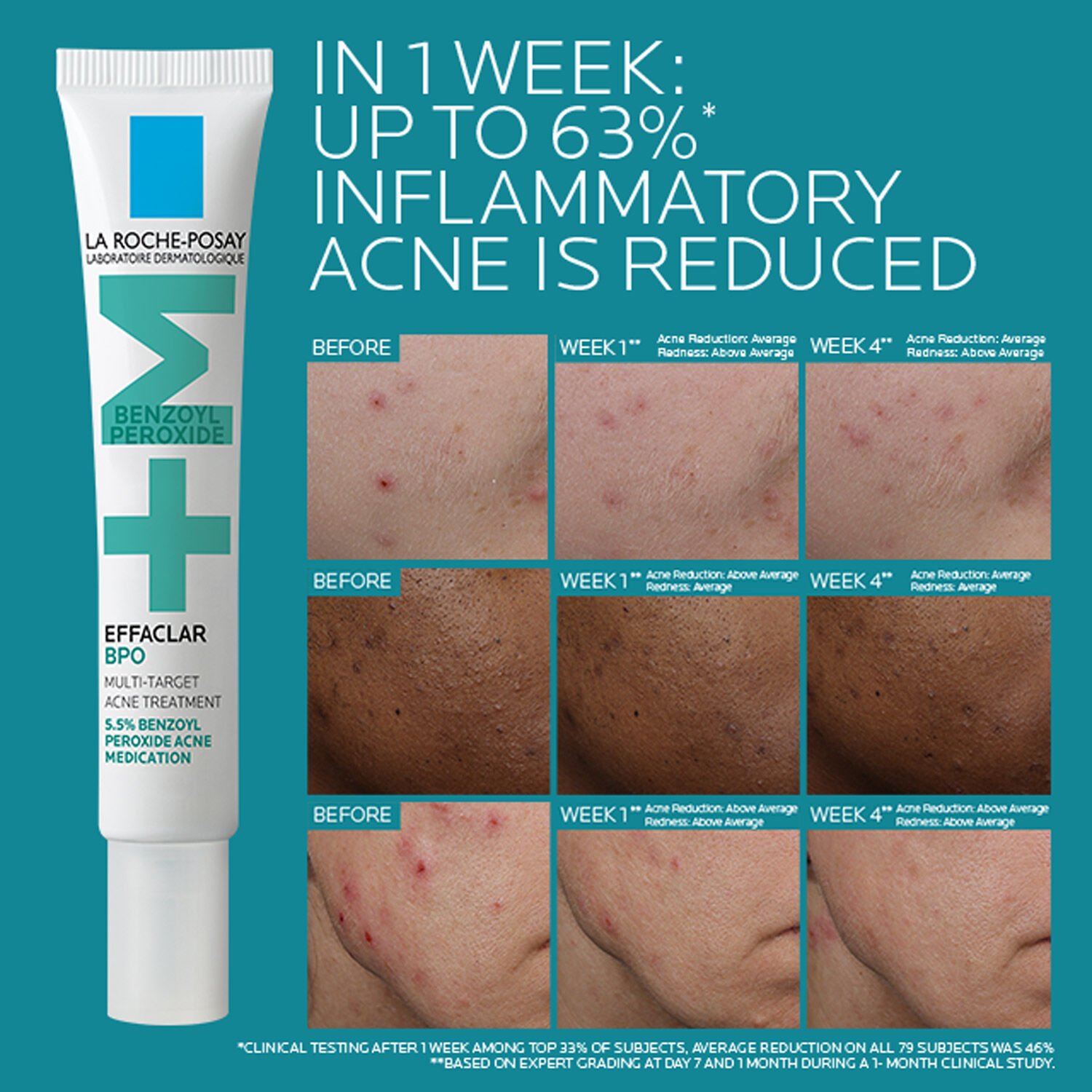 Effaclar BPO Multi-Target Acne Treatment with 5.5% Benzoyl Peroxide