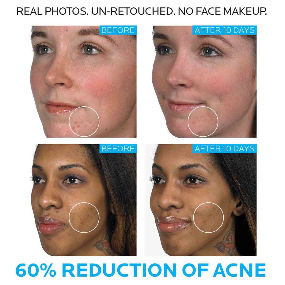 Effaclar Duo Acne Spot Treatment La Roche Posay effaclar-duo-acne-spot-treatment-la-roche-posay