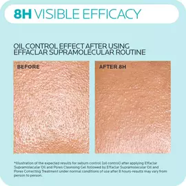 Effaclar Stubborn Acne Kit