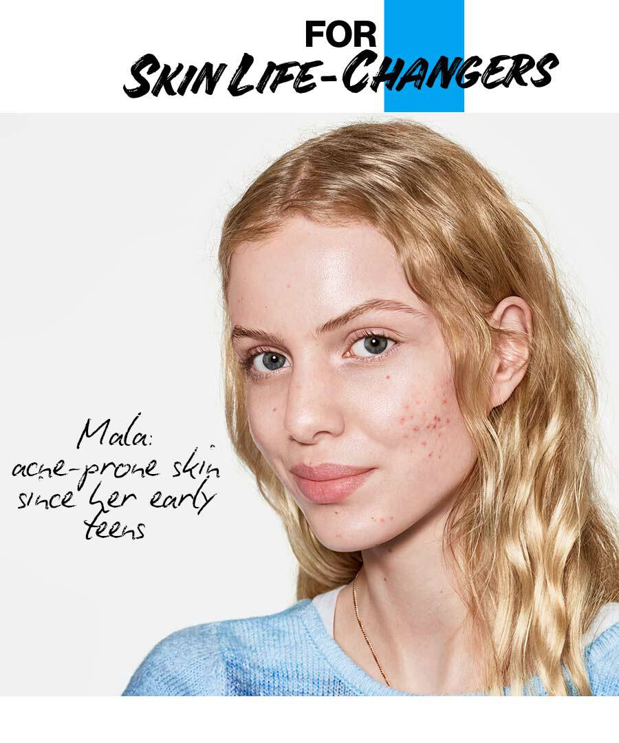 Mala: acne-prone skin since her early teens
