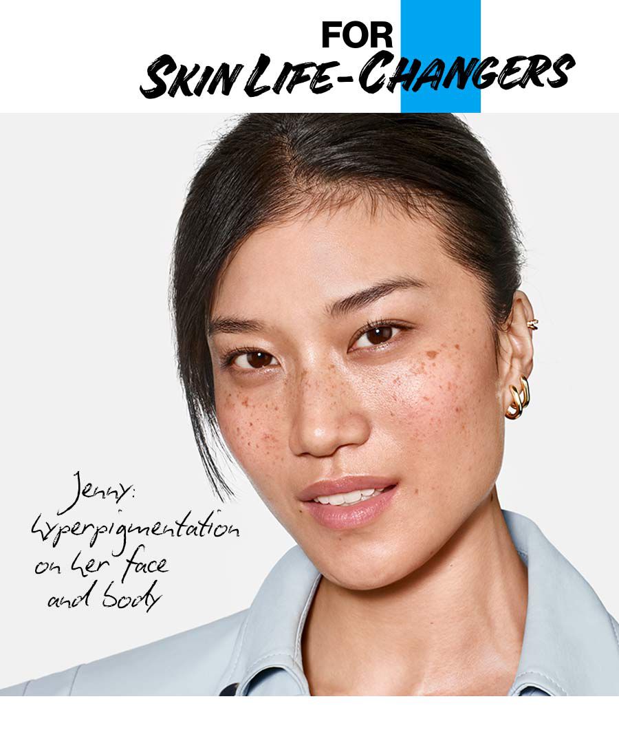 Jenny: hyperpigmentation on her face and body