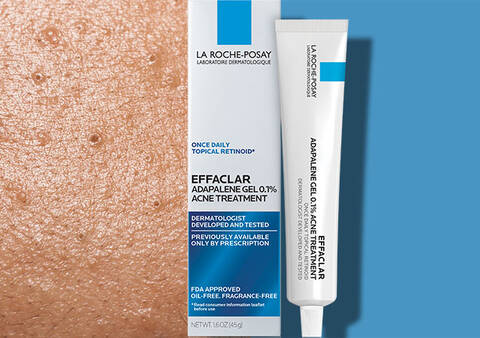 Illustration of Acne Treatment For Whiteheads