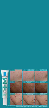 Effaclar BPO Treatment Before and After Images