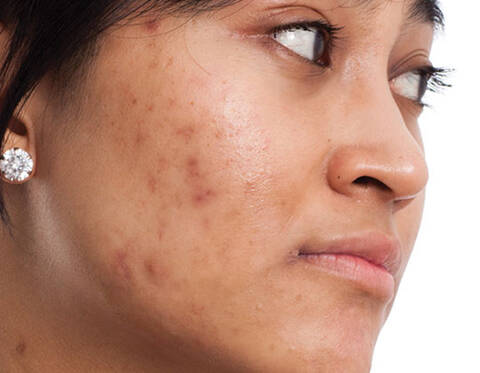 When Does Acne Stop? Understanding The Causes & Treatments