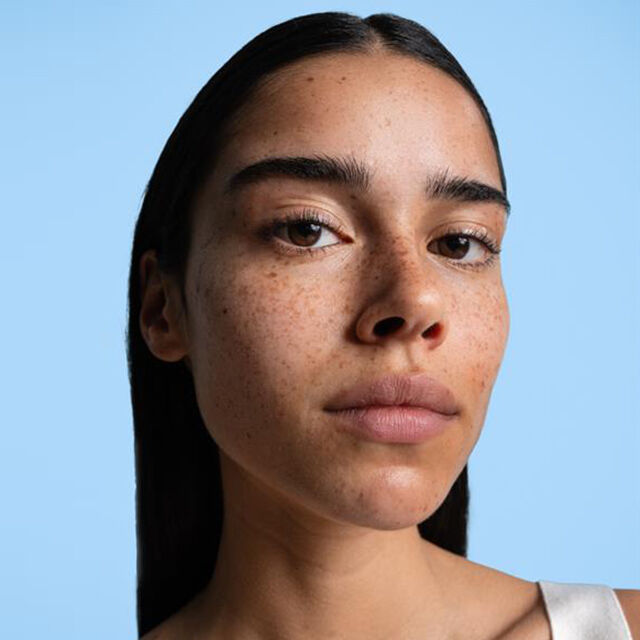 SEPTEMBER 1ST IS ACNE POSITIVITY DAY