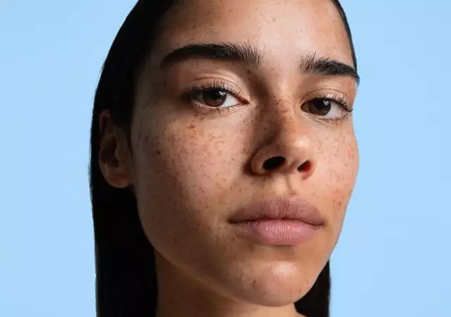 SEPTEMBER 1ST IS ACNE POSITIVITY DAY