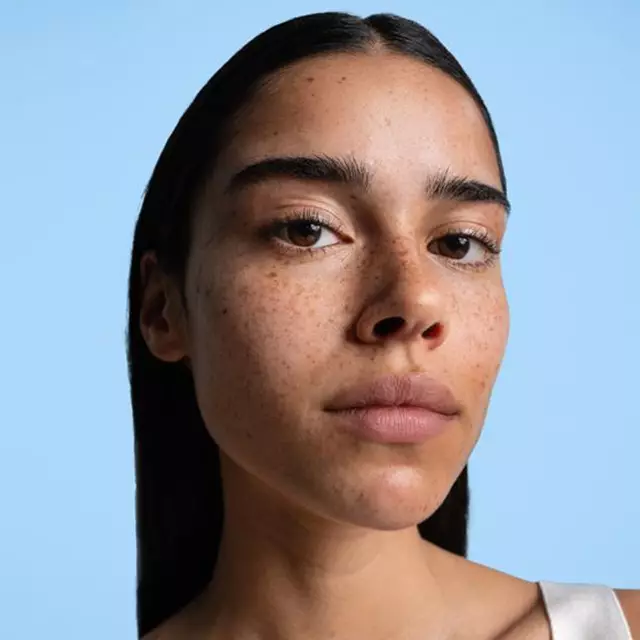 SEPTEMBER 1ST IS ACNE POSITIVITY DAY