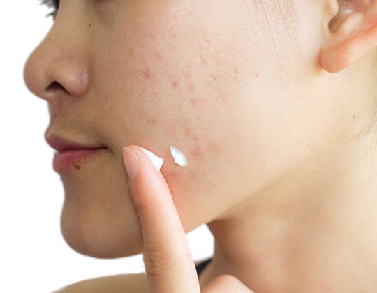 How to Get Rid of Blackheads, According to Dermatologists in 2023 — Expert  Tips, Product Recommendations