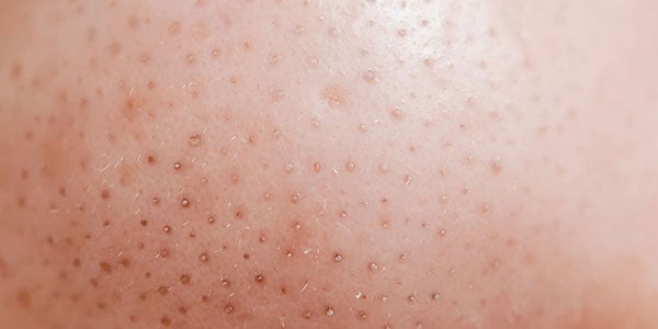 How to Get Rid of Blackheads La Roche Posay