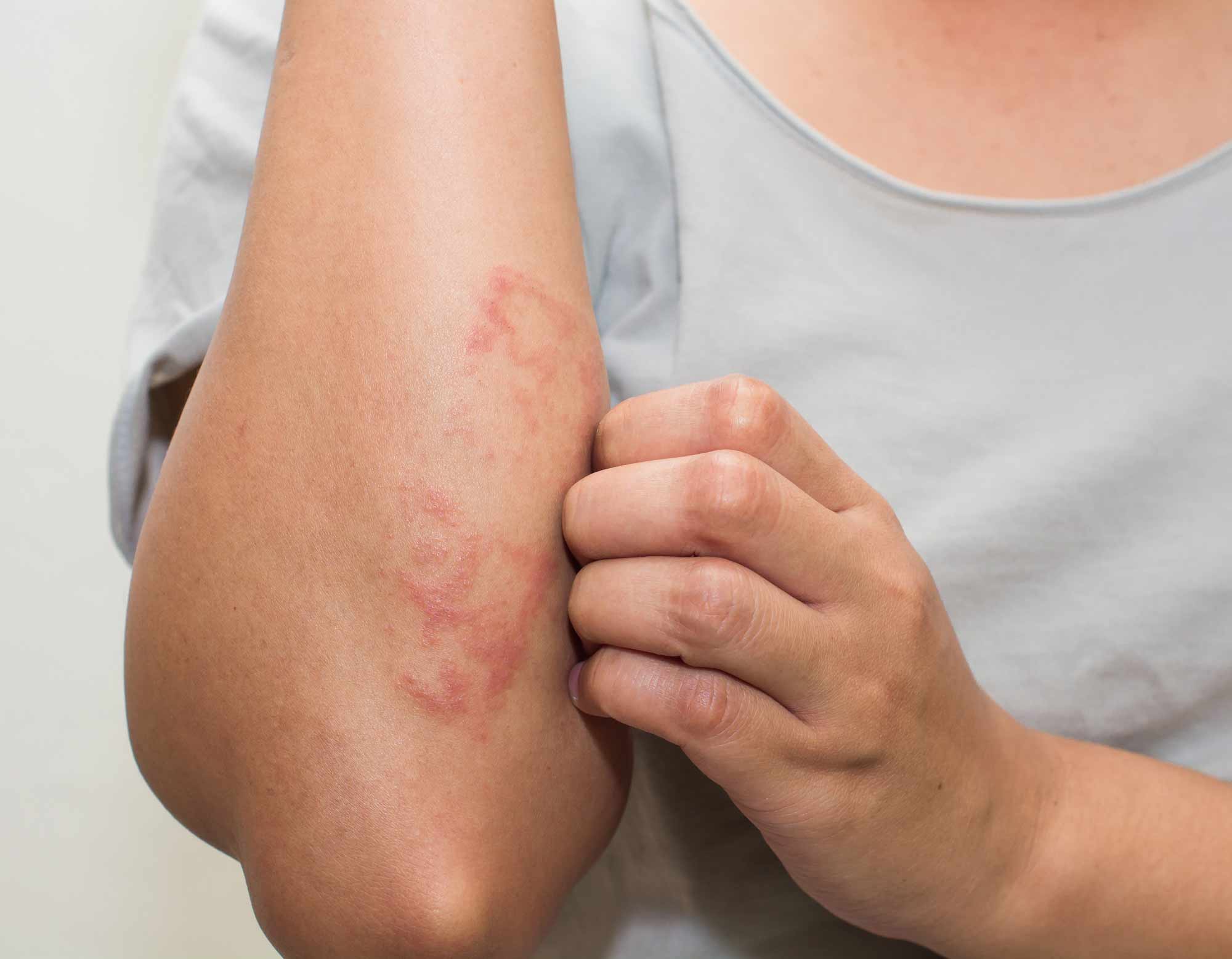 Skincare Ingredients to Avoid for Eczema | La Roche Posay